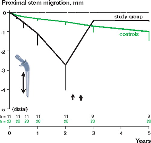 Figure 3. Proximal/distal migration of the stem (mean, SE). Because of massive subsidence, the 2 loosenings have a considerable influence on the mean values before revision (arrows). Black: study group; green: controls.