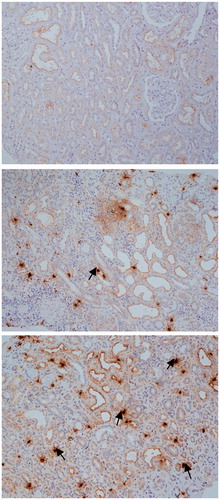 Figure 1. The distribution of MCs in patients with anti-GBM nephritis: immunohistochemical (IH) staining showing tryptase expression in the kidney of normal control (A), patients with anti-GBM nephritis in group 1 (B) and in group 2 (C) (IH, 200×).