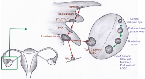 Figure 2 Proposed models for the development of type 1 and type 2 tumors of the ovary.