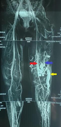 Figure 3 MRI showing lateral marginal vein (yellow arrow), perforator vein (blue arrow) and an isolated segment of a vestigial or hypoplastic femoral vein (red arrow).