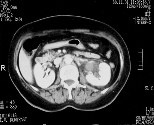 Figure 1. On contrast-enhanced abdominal CT image at level renal hilum, hemorrhage in the left renal pelvis and perirenal area.