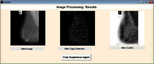 Figure 2 Mammogram enhancement using Contrast Limited Adaptive Histogram Equalization (CLAHE).