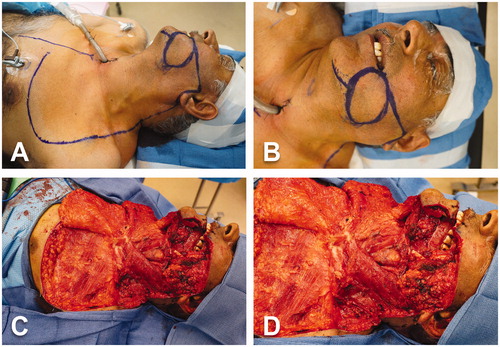 Figure 2. Intraoperative views. (A-B) Marking of the oncological skin excision on the left cheek and design of the large medially-based left cervicothoracic rotation flap. (C–D) Cervicothoracic flap already harvested and reflected medially. Completion of tumor resection (including surrounding tissues and cheek skin), segmental mandibulectomy and left modified radical neck dissection.