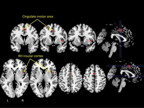 Figure 3. The results of a statistical “conjunction” analysis between the ALE meta-analyses of swallowing and micturition illustrated in Figure 2. The conjunction analysis revealed only two brain areas that reached statistical threshold: the insular cortex of the right hemisphere (RH) and the mid-cingulate cortex (cingulate motor area) bilaterally.