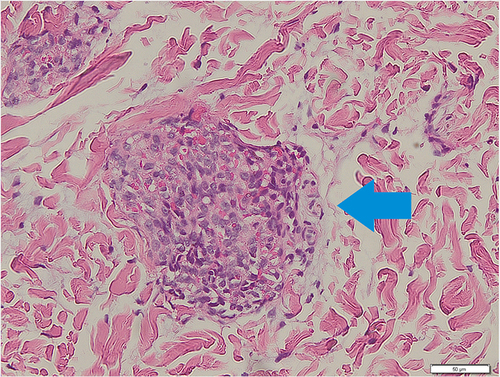 Figure 2 Round oval spindle cells resembling “cannon ball” appearance (blue arrow) (Hematoxylin-eosin stain, 200x magnification).