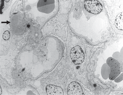 Figure 1. Electron microscopy showing moderately enlarged mesangium and a mesangial electron-dense deposit (arrow).