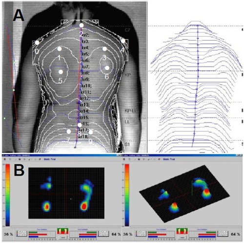 Figure 1 Moiré topography examination and pedobarographic measurements of the distribution of body mass between the body sides.