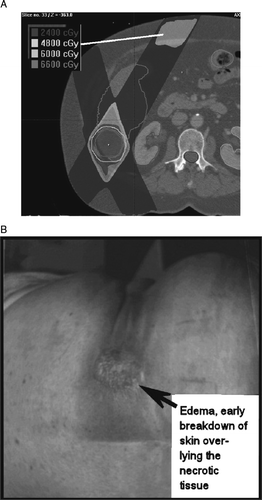 Figure 4.  Grade 3 soft tissue toxicity. A, SBRT isodose distribution; line points to area of injury, all within a subcutaneous volume that received more than 48 Gy. B, photograph obtained 8 months after SBRT.