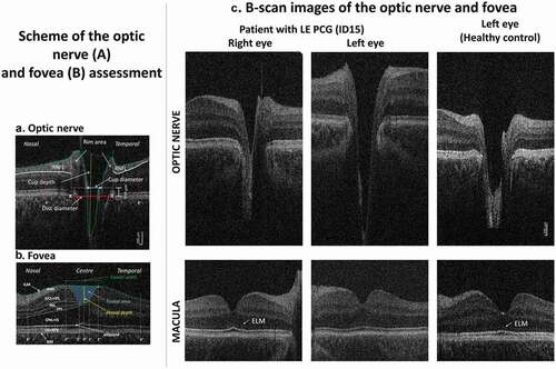 Figure 1. HH-OCT images of the optic nerve (ON) (A) and fovea (B): (A) horizontal B-scan through the center (deepest excavation) of the optic disc; the disc diameter was defined as an interval between the edges of Bruch’s membrane (red line), the cup diameter as the distance between the nasal and temporal internal limiting membrane (green dotted line) 150 μm anterior to the plane of the disc (blue line), the rim area consisted of the area anterior to the same plane (white dotted lines) within the disc edges (white vertical lines) and the internal limiting membrane (green dotted lines); maximal cup depth (vertical yellow line) was measured using a line perpendicular to the line between the cup diameter (blue line) and the deepest point of the cup; RNFL thickness was measured at 6° from disc margins (red dotted lines). (B) Horizontal B-scan of the fovea with labeled individual retinal layers (BM, Bruch’s membrane; ILM, inner limiting membrane; RNFL, retinal nerve fiber layer; GCL, ganglion cell layer; INL, inner nuclear layer; IPL, inner plexiform layer; IS, inner segment; ONL, outer nuclear layer; ELM, external limiting membrane; OPL, outer plexiform layer; OS, outer segment; RPE, retinal pigment epithelium). Retinal layer thickness was measured in the center of the fovea, in the paracentral area (from 1° nasally to 1° temporally) and nasally and temporally (from 2° to 6°). The green line connecting the most prominent positions of the ILM nasally and temporally was used to define the foveal width; the yellow line indicates the foveal depth (the axial distance from the green line to the deepest point of the foveal pit); the area in blue indicates the foveal pit area. (C) Horizontal spectral domain–optical coherence tomography B-scan images of the optic nerve (top) and fovea (bottom) of a patient with primary congenital glaucoma in the left eye (PCG, middle column), an unaffected right eye (left column) and an eye of a healthy age-, gender- and ethnicity-matched control child (right column). On the ON scan, a larger and deeper cup is seen in PCG. On the foveal scan, the ELM is not visible in PCG while it is distinctly seen in the unaffected eye and in the healthy control. Reprinted with permission from [Citation60], licensed under https://creativecommons.org/licenses/by/4.0/.