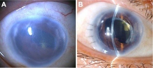 Figure 3 Slit-lamp photographs in case 1 with microcornea and iridocorneal endothelial syndrome. (A) Preoperatively, severe corneal edema, pupil deformity, and near 360° peripheral anterior synechia were noted. (B) Postoperatively, the cornea became clear. Best-corrected visual acuity improved from 20/1000 to 20/100.