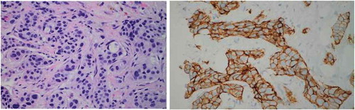 Figure 1. Left: H&E stain of left breast biopsy. Right: Left breast mass biopsy staining for Her2.
