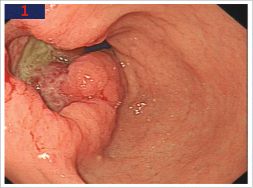 Figure 1. Endoscopy shows an ulcero-infiltrative lesion with irregular base and abnormalities of surrounding folds.