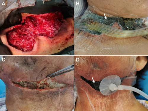 Figure 1 Vacuum-assisted closure (VAC) in the treatment of deep neck infection. Simultaneous VAC: (A) The abscess cavity was exposed, and necrotic tissues were removed. (B) The foam material was then placed into the infected area, and the transparent film completely covered the wound to ensure sealing. In addition, the VAC device was connected. Staged VAC: (C) Infection wound failed to heal after conventional drainage and repeated debridement. (D) The VAC device was then placed into the infected area to facilitate wound healing. White arrows in (B and D) indicate the foam material and the transparent film, respectively.