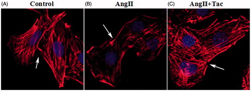 Figure 3. AngII-induced actin cytoskeleton disruption. Notes: Fluorescence microscope ×400. (A) Untreated podocytes, white arrow showed the fine connection of podocyte foot processes; (B) AngII-treated podocytes induced the loss of the cytoplasmic cytoskeleton and the reorganized of actin cytoskeleton at 24 h, white arrow showed the disruption of podocyte foot processes connection; (C) Tacrolimus inhibited the injury of AngII, maintained well-defined actin stress fibers, white arrow showed the maintain of podocyte foot processes connection.