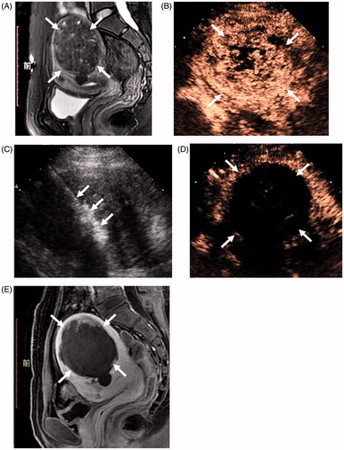 Figure 1. Examinations of a patient with fibroids before and after ablation. (A) MRI (T2WI) before ablation showed the fibroid. (B) Before ablation, the contrast-enhanced ultrasonography (CEUS) image showed non-homogeneous enhancement within the fibroid. (C) During ablation, tissue effects of ablation. (D) After ablation, no contrast enhancement was observed in the ablation area. (E) Contrast-enhanced MRI 3 days after ablation showed the ablation zone.