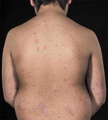 Figure 1 Mixed plaque and guttate psoriasis on the back of a 9-year-old boy.