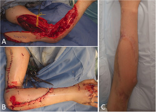 Figure 5. Intraoperative photographs of the patient in Case 2. (A) A 20 × 7 cm reverse lateral upper arm flap was designed. (B) The donor site was closed primarily. (C) One year and 5 months after flap implantation.