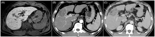 Figure 3. A 48-year-old man with liver cirrhosis due to chronic hepatitis B viral infection. (A) Hepatobiliary phase magnetic resonance image shows a 2.1-cm hepatocellular carcinoma (arrow) abutting the right anterior portal vein and right anterior bile duct (arrowheads) in segment 8. (B) Portal-phase computed tomography scan obtained immediately after radiofrequency ablation shows that the tumor is completely ablated with no immediate procedure-related complications. (C) Additional computed tomography (CT) scan obtained 4 days after the procedure because of high fever and abdominal pain. Portal-phase CT image shows air bubbles (arrowhead) in the radiofrequency ablation (RFA) zone and fat stranding in the perihepatic space near the RFA zone, indicating possible abscess and inflammation. The patient’s condition recovered after administration of empirical antibiotics.