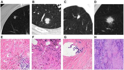 Figure 1 Solid SPINs with smooth margin (type Ia) (A), coarse margin (type Ib) (B), sparse and long spiculations (type Ic) (C), and sparse and short spiculations (type Ic) (D). Pathologically, they have similar manifestations including significant fibrous tissue proliferation, hyaline change and few chronic inflammatory cells infiltration (E–H).