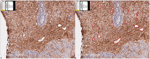 Figure 1. Imaging analysis method of CD31 immunostaining results. All stains were scanned using an Aperio AT2. The lumens of all stained vessels were manually marked using an Aperio imagescope programme.
