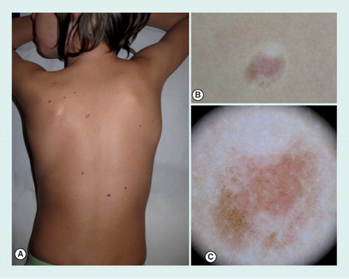 Figure 1. Clinical and dermoscopic image of a halo nevus on the back of a 4-year-old girl.(A) Clinical overview. (B) Close-up clinical image showing a pigmented lesion surrounded by a whitish halo. (C) With dermoscopy, the lesion appears almost completely involuted, with a homogeneous pattern, surrounded by a rim of scar-like depigmentation.