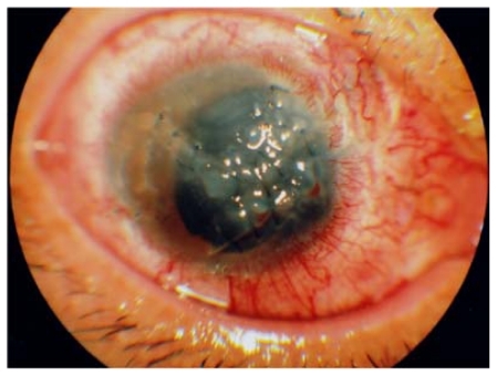 Figure 1 Anterior segment of the right eye at first visit. Note the rough surface and opacity of the cornea due to multiple penetrating injuries.