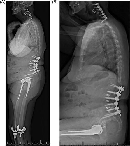 Figure 1 Sample case: (A) standing and (B) sitting lateral stereoradiographic images (EOS Imaging, Paris, France / ATEC Spine, Carlsbad, CA) demonstrating both a spinal deformity correction and bilateral hip arthroplasty.