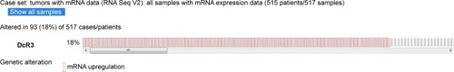 Figure 2 The upregulated expression of DcR3 in all samples of adenocarcinoma.
