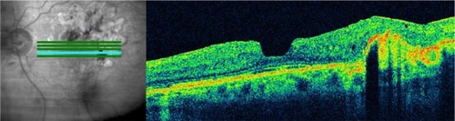 Figure 22 Laser treatment of subretinal neovascularization leads to atrophic scarring, which appears, on Cirrus™ optical coherence tomography, as highly reflective at the chorioretinal interface.