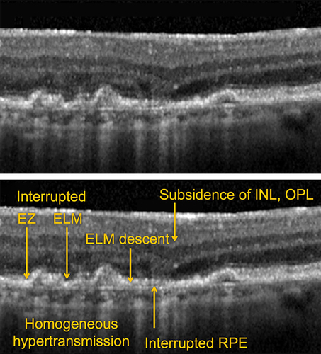 Figure 3 Incomplete Retinal pigment epithelium and Outer Retinal Atrophy (iRORA).