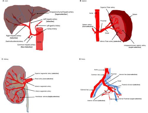 Figure 1 Examples of selectivity and proximity of angioembolization in different injured organs (A: liver, B: spleen, C: kidney, D: pelvis).