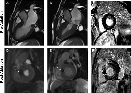 Figure 2. Cardiovascular magnetic resonance images before and after alcohol septal ablation. Steady-state free procession (SSFP) diastolic (A) and systolic (B) still-frame, long-axis images demonstrating hypertrophic obstructive cardiomyopathy with left ventricular outflow tract obstruction and secondary, severe eccentric mitral regurgitation (cine images provided in supplement). Delayed enhancement image post-gadolinium reveals no evidence of myocardial fibrosis (C). Prior to hospital discharge, repeat CMR was performed. A large, transmural, non-enhancing area of necrosis (arrow) was visualized in the basal anteroseptum on perfusion (D) and still-frame SSFP (E) images. Post-alcohol septal ablation cine images are provided in the supplement. Short-axis delayed enhancement image (F) reveals large area of microvascular obstruction, or ‘no reflow,’ as demonstrated by the large, non-enhancing inner core.