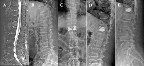 Figure 3 A 70 years old male patient with T12 vertebral compression fracture underwent PKP. (A) T2 fat suppression MRI showed a fresh compression fracture of T12; (B) preoperative lateral fluoroscopy; (C and D) anteroposterior and lateral fluoroscopy 1 day post operation; (E) Lateral plain film at 1 month post operation showed the treated vertebra recollapsed and diffusely injected PMMA was condensed.
