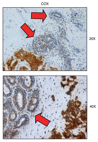 Figure 8 COX activity is higher in human epithelial cancer cells, relative to normal adjacent epithelial ductal cells. Frozen sections of human breast cancer samples were subjected to COX activity staining (brown color). Slides were then counter-stained with hematoxylin (blue color). Note that epithelial cancer cells were also more intensely stained than adjacent normal epithelial cells that were part of mammary ductal tissue. Thus, COX activity staining can be used to distinguish normal epithelial cells from adjacent cancer cells, within the same tumor tissue. Original magnification, 20x and 40x, as indicated.