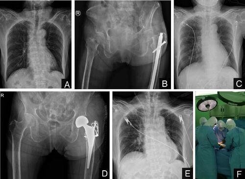 Figure 2. Chest radiographs (Panels A and C) obtained in a local clinic (A) and after presentation to our hospital (C) showing no active pulmonary lesions. Panel B shows a left femur neck fracture. Panels D and E are plain radiographs taken the day after surgery. Panel F shows the surgical team performing surgery while wearing level D PPE.