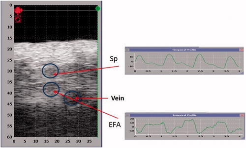Figure 6. B-mode image of the treated region while targeting the femoral artery. The strain imaging on the right hand side shows arterial pulsations indicative of existing arteries in the region of interest. FA, femoral artery; Sp, saphenous artery.