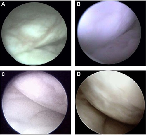 Figure 2 Arthroscopic images in two patients before operation and at 6 and 24 months after surgery.