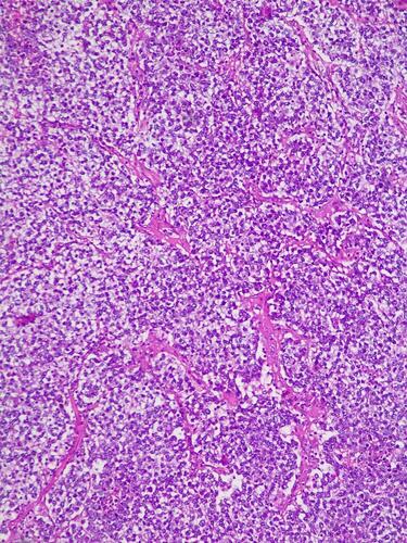 Figure 6 Histology features of ovarian dysgerminoma. Sheets and nests of monotonous tumor cells separated by thin fibrous septa. Cells are polygonal with well-defined cell borders and abundant clear cytoplasm (HE x 10).