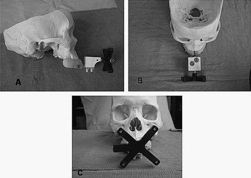 Figure 2. The EarMark™ system as arranged for operative use. Panel A shows a side view, Panel B an overhead view, and Panel C a frontal view. The mouthpiece-like LADS is seen in blue with a Plexiglas extender jutting out anteriorly. The infrared (IR) emitter is the black X-shaped device. This is connected to the LADS via the customized adapter (in white) which allows positioning of the IR emitter in an identical fashion both with and without the EarMark™.