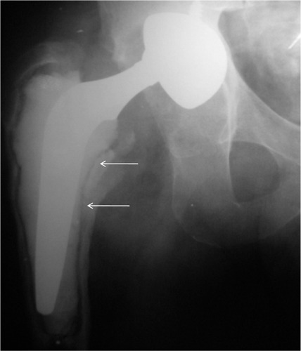 Figure 3 Radiologic osteolysis in Gruen zones 6 and 7 (white arrows).