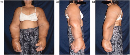 Figures 1. (a–c) Physical findings: The bilateral overgrowth of the upper extremities occurred, extending from the shoulders to the fingers. Both the length and circumference of the upper extremities increased.