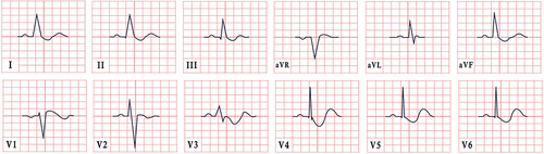 Figure 9 ECG features in hypokalemia. This ECG depicts sinus rhythm, normal cardiac axis, widespread ST segment depression, associated with T wave inversion and the presence of U waves.