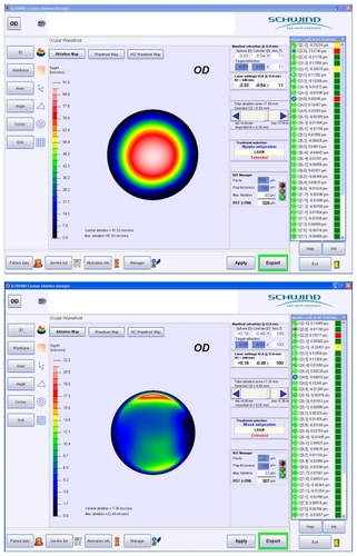 Figure 1 Wavefront map of a patient in Group B before (A) and after (B) treatment, showing an almost stable amount of vertical coma.