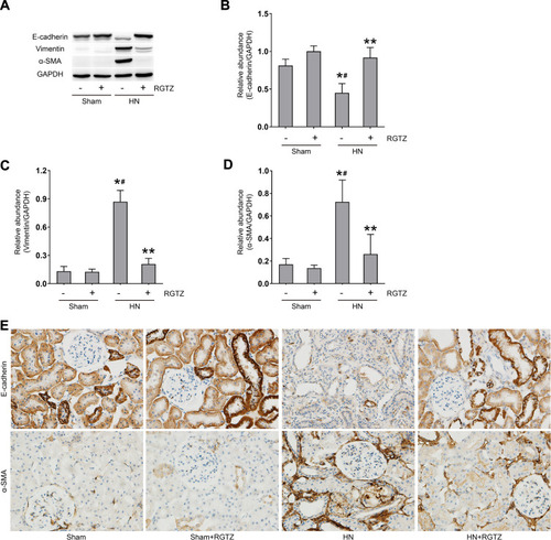 Figure 5 RGTZ inhibits renal tubular epithelial-to-mesenchymal transition in the kidneys of HN rats. (A) Kidney tissue lysates were subjected to immunoblot analysis with specific antibodies against E-cadherin, vimentin, α-SMA, or glyceraldehyde 3- phosphate dehydrogenase (GAPDH). (B) Expression levels of E-cadherin were quantified by densitometry and normalized to GAPDH. (C) Expression levels of vimentin were quantified by densitometry and normalized to GAPDH. (D) Expression levels of α-SMA were quantified by densitometry and normalized to GAPDH. (E) Photomicrographs (original magnification, ×400) illustrate immunohistochemical staining of E-cadherin and α-SMA in the kidney tissues. RGTZ, rosiglitazone. Data are represented as the mean ± SEM. *p < 0.05 vs sham group; #p < 0.05 vs sham + RGTZ group. **p < 0.05 vs HN group.