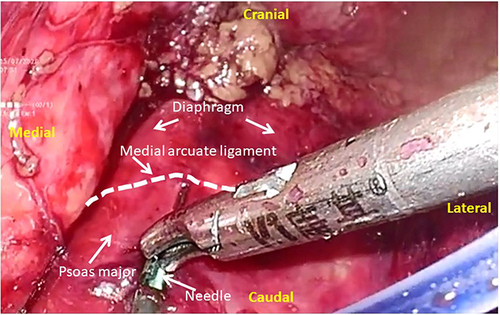Figure 2 The DAZ block with 20 mL of 0.5% ropivacaine via the medial arcuate ligament under direct laparoscopic visualization was performed.