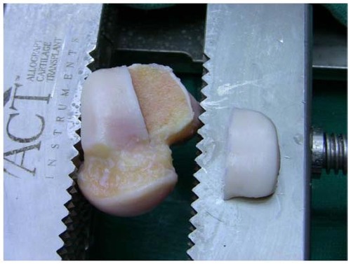 Figure 4 Preparation of a fresh osteochondral lateral hemitalus allograft.