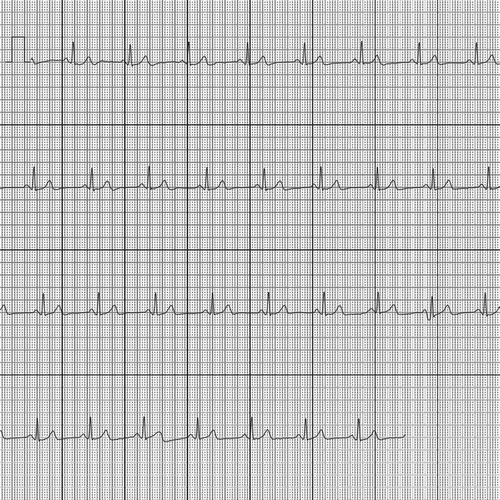 Figure 4. An example of an ECG generated by AliveCor.