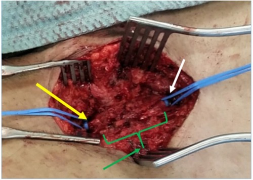 Figure 3 Left groin exposure with the left common femoral artery (white arrow) and its bifurcation (yellow arrow) controlled with vessel loops and complete loss of arterial structure in between (green arrow).