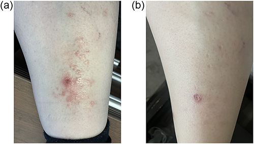 Figure 1 (a) Pink papules and plaques with some central atrophy on the left pretibial region status post shave biopsy. (b) After one month of use, all but two lesions are healed (the biopsy site and one lesion on the medial aspect of the pretibial region), leaving behind atrophic scars.