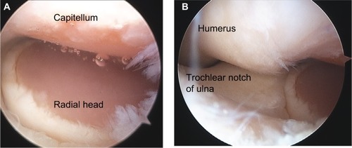 Figure 8 Arthroscopic appearances of the left elbow of a 43-year-old male patient with severe elbow pain referred with a diagnosis of “resistant epicondylitis.”